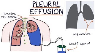 Understanding Pleural Effusions [upl. by Cyma]