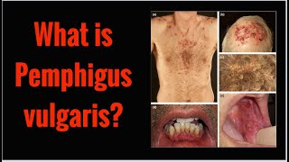 What is PEMPHIGUS VULGARIS Symptoms Causes [upl. by Anitsugua]