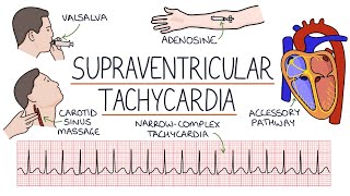 Understanding Supraventricular Tachycardia SVT [upl. by Anuaek885]