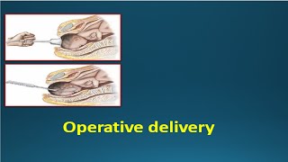 OPERATIVE DELIVERY  Instrumental deliveries Vacuum amp Forceps [upl. by Maxia]