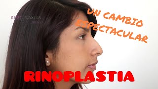 Rinoplastia Lima Rinoplastia Perú  Rinoplastia Antes y Después Mujeres Especialista en Rinoplastia [upl. by Tomasina]