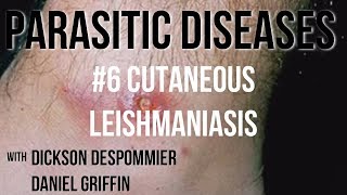 Parasitic Diseases Lectures 6 Cutaneous Leishmaniasis [upl. by Hsima895]