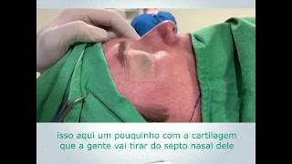 Rinoplastia Perfeita ANTES e DEPOIS  Cirurgia [upl. by Ralston29]