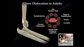 Elbow Dislocation In Adults  Everything You Need To Know  Dr Nabil Ebraheim [upl. by Fosdick691]