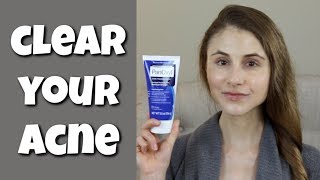 HOW TO CLEAR YOUR SKIN WITH BENZOYL PEROXIDE DR DRAY [upl. by Colligan]