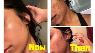 THE ORDINARY SKINCARE  HOW TO GET RID OF DARK SPOTS [upl. by Vittoria]