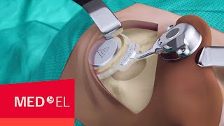 BONEBRIDGE BCI 602 Implant Surgery  MEDEL [upl. by Hsiekal]