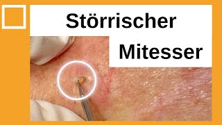 Störrischer Mitesser entfernt Dr Kasten Hautmedizin in Mainz [upl. by Lauralee]