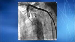 Chapter 5 Subclavian Innominate amp Aortic Arch Regions [upl. by Rexer51]