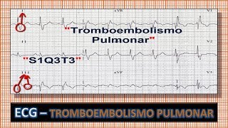 ECG  Eletrocardiograma com Tromboembolismo Pulmonar [upl. by Llerrod]