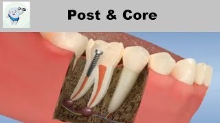 Post and Core After Root Canal Treatment [upl. by Peggy31]