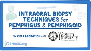 Intraoral Biopsy Techniques for Pemphigus amp Pemphigoid in Collaboration w Western University [upl. by Yelrebma]