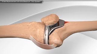 Knee Replacement Revision Why How and What to Expect [upl. by Eniawtna]