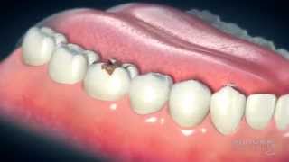 Dental Crowns Everything You Need to Know [upl. by Pietro]