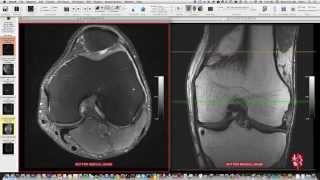 Systematic Interpretation of Knee MRI How I do it [upl. by Eiramave]