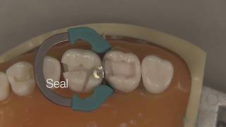 Class II Composite Restoration  Stevenson Dental Solutions [upl. by Wheelwright58]