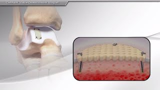 Management of Ankle Osteochondral Lesions [upl. by Giraud497]