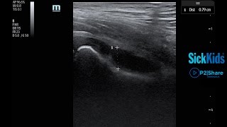 Identifying a Hip Effusion Using POCUS [upl. by Emlyn874]