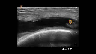 Knee Effusion Ultrasound Image Interpretation [upl. by Anahgem513]