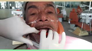 HOW TO RECORD JAW RELATIONS IN COMPLETE DENTURE PATIENT [upl. by Armalda]