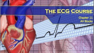 The ECG Course  AV Blocks [upl. by Llekcor]