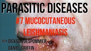 Parasitic Diseases Lectures 7 Mucocutaneous Leishmaniasis [upl. by Nanyk]