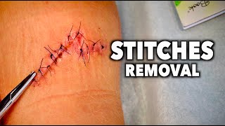 REMOVING 13 STITCHES From a Huge Leg Wound  Dr Paul [upl. by Ginnifer]