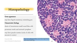 Ewings Sarcoma [upl. by Yssac300]