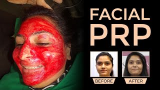 Facial PRP Procedure  Before and After Results  PRP  Dr Jagdish Sakhiya  Sakhiya Skin Clinic [upl. by Simone]