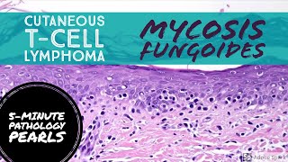 Mycosis Fungoides Cutaneous TCell Lymphoma 5Minute Pathology Pearls [upl. by Loydie250]