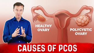 Do all Ovarian cysts need surgery or treatmentDr Sanjay Panicker [upl. by Fernandina]