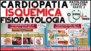 CARDIOPATÍA ISQUÉMICA FISIOPATOLOGÍA  GuiaMed [upl. by Laynad]