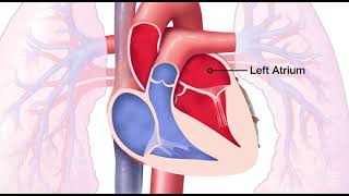 Mitral Valve Regurgitation [upl. by Caralie123]