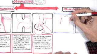 Bowel Obstruction  Causes and Pathophysiology [upl. by Antonius]