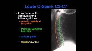 Radiology of Spine Trauma [upl. by Rozella]