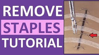 Surgical Staple Removal Nursing  How to Remove Surgical Staples [upl. by Asilana]