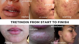 TRETINOIN BEFORE AND AFTER  FULL TRETINOIN EXPERIENCE my journey from start to end Adult Acne [upl. by Perloff355]