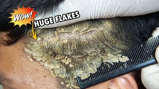 Huge Dandruff Flakes Removing and Picking 635 [upl. by Beasley226]