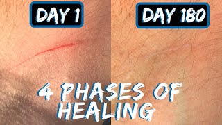 Cut Healing Over Time  6 Months [upl. by Anelrahc]