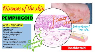 Pemphigoid Causes pathogenesis Types Histopathology Treatment  Pemphigus vs Pemphigoid [upl. by Calisa]