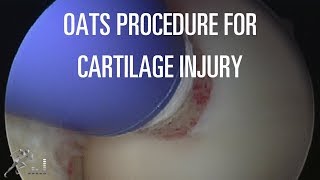 Repairing Knee Cartilage with an OATS Procedure [upl. by Stanwin]