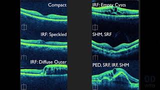 Macular OCT Interpretation A Practical Discussion with Dr David E Lederer [upl. by Deuno]