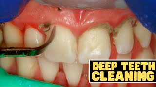 Teeth Cleaning vs Deep Cleaning  Dentist Reviews How Teeth Are Cleaned [upl. by Mil]