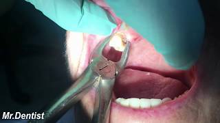 Extraction Of Molar Tooth [upl. by Gnilrets]