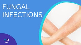 Fungal Infections  Causes Prevention and Cure [upl. by Sharlene964]