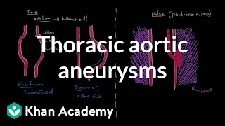 Thoracic aortic aneurysms  Circulatory System and Disease  NCLEXRN  Khan Academy [upl. by Oicram]