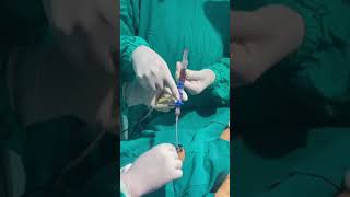 Double volume exchange transfusion for hyper bilirubinemia At NICU CMC [upl. by Hanschen]